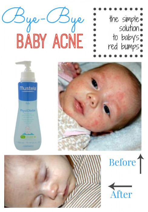 Bye-Bye Baby Acne - the simple solution to baby's red bumps